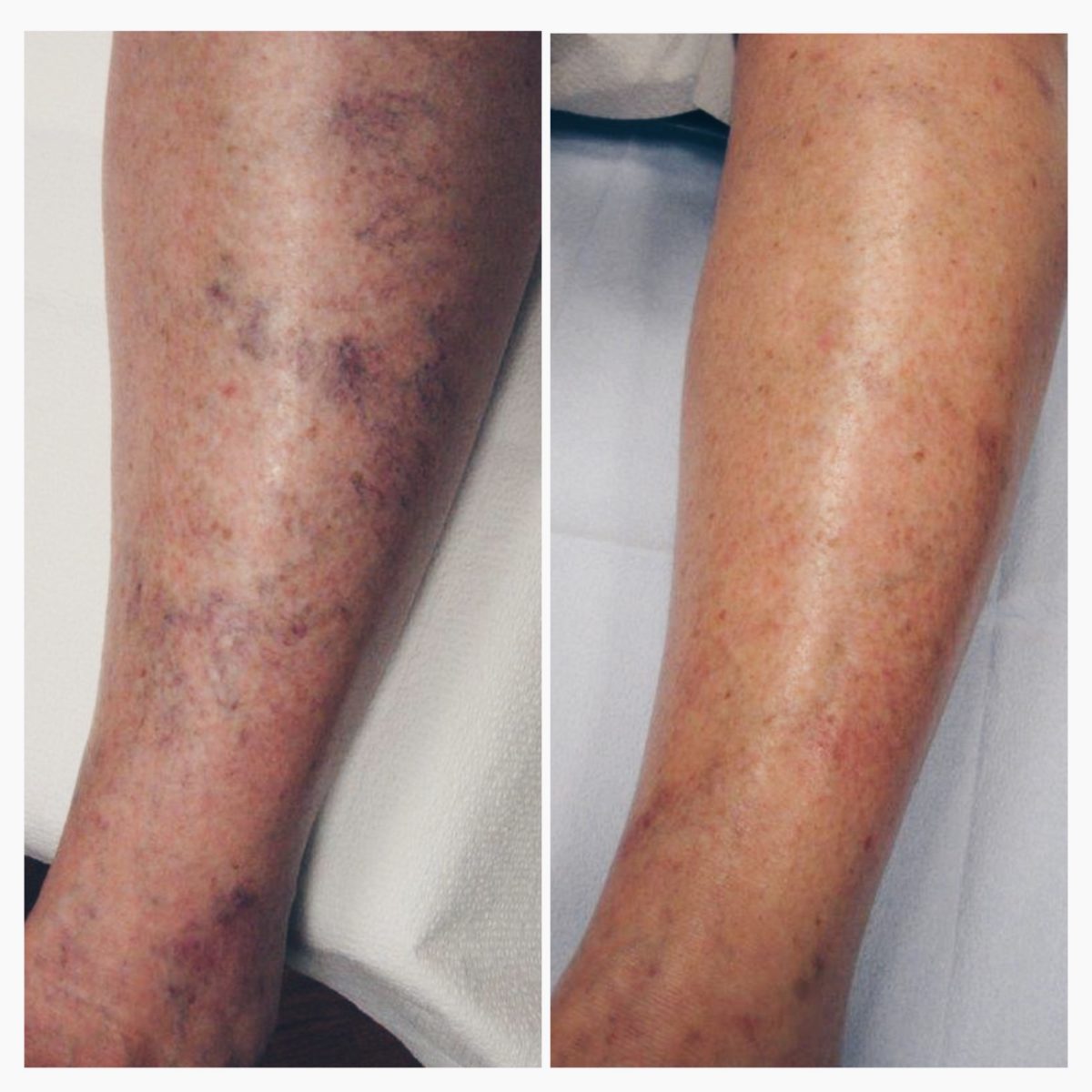 Topical Laser for Spider Veins | The Vascular Experts