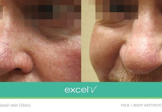 https://thevascularexperts.com/wp-content/uploads/2022/06/2-treatments-laser-for-facial-veins-540x372.jpg