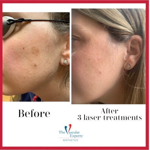 https://thevascularexperts.com/wp-content/uploads/2022/06/3-sessions-of-brown-spot-removal.jpg