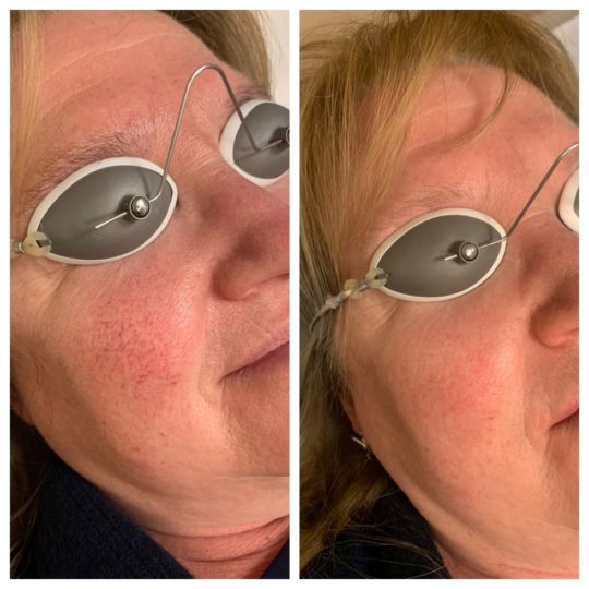 https://thevascularexperts.com/wp-content/uploads/2022/06/facial-vein-removal-by-laser2-540x540.jpg