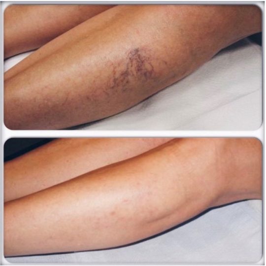 https://thevascularexperts.com/wp-content/uploads/2022/06/sclerotherapy-540x540.jpg